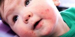الطفح الجلدي لدى الأطفال خلال فترة التسنين