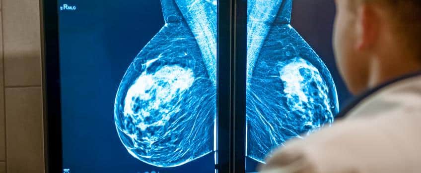 كم تعيش مريضة سرطان الثدي
