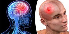 أعراض سرطان الرأس