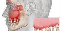 أعراض التهاب عصب الأسنان