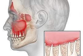 التهابات عصب الاسنان