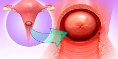 هل التهابات عنق الرحم تمنع الحمل