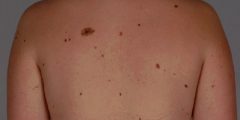 كم يعيش مريض سرطان الجلد