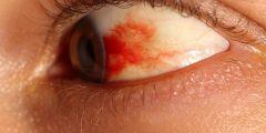 شعيرات دموية في بياض العين