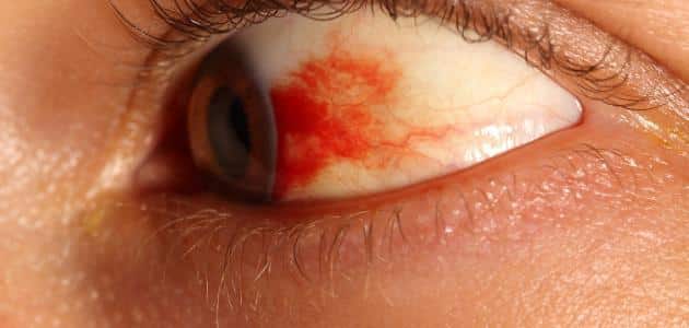 شعيرات دموية في بياض العين