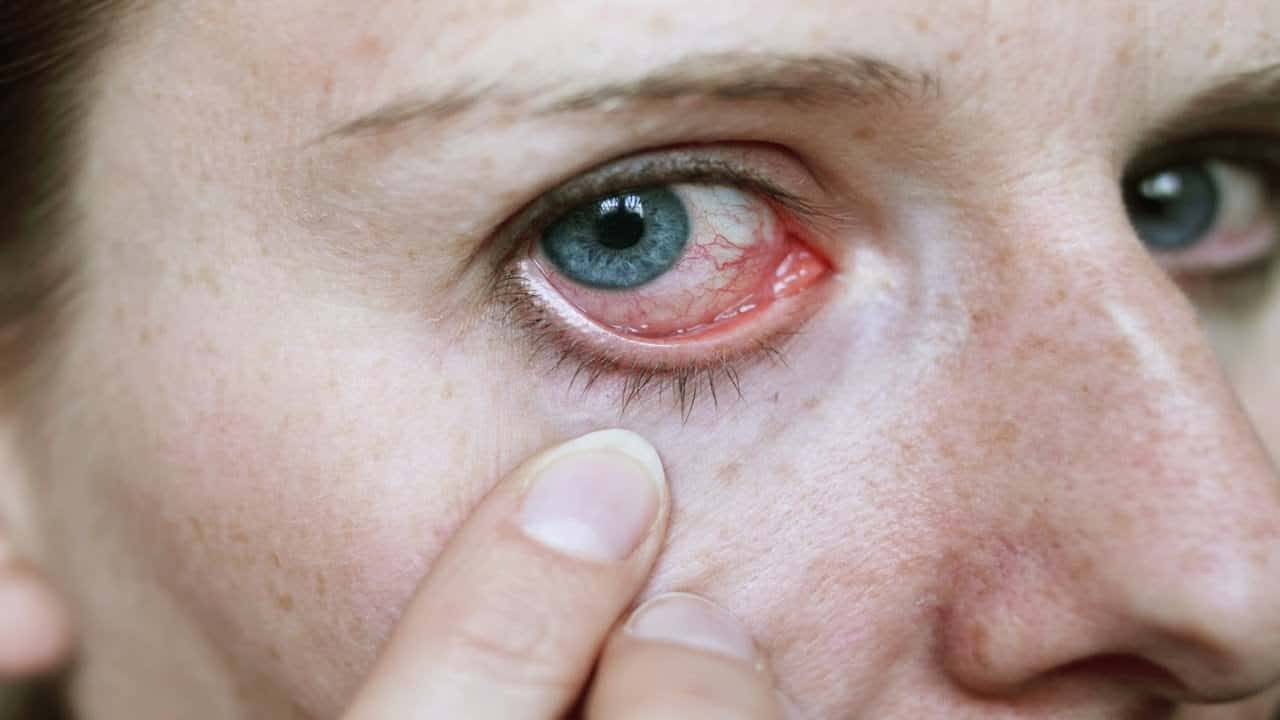 علاج حساسية العين واحمرارها