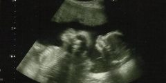 وفاة الجنين في الشهر الرابع